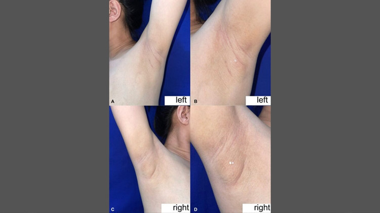 filipinli kadinin koltukaltindan sut geldi nadir gorulen durumun nedeni ne a2iTBU5O.jpg